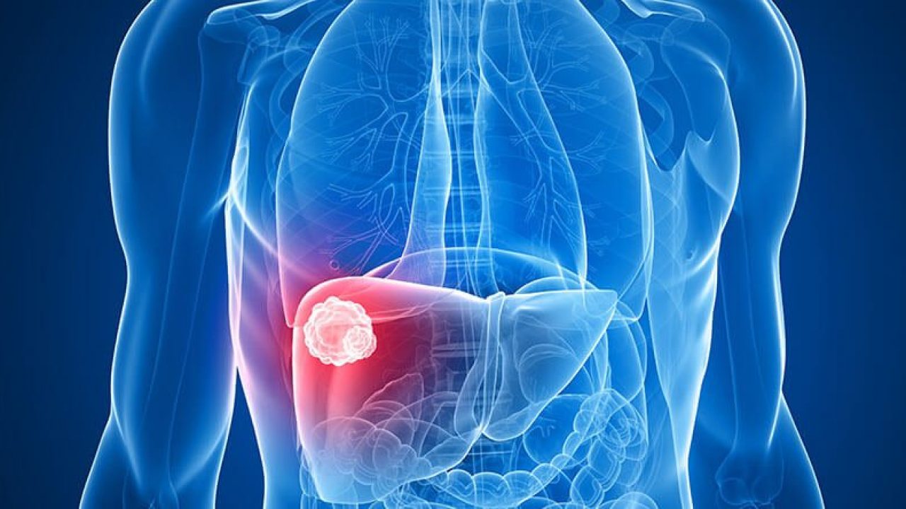 Các liệu pháp điều trị và chẩn đoán ung thư gan